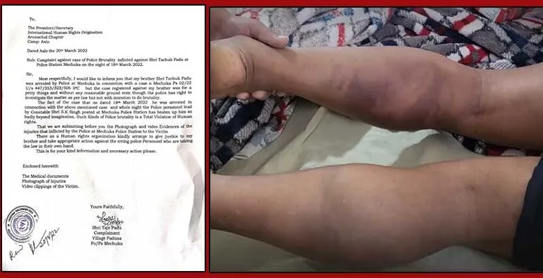 Arunachal: Man alleges police brutality in Mechukha PS
