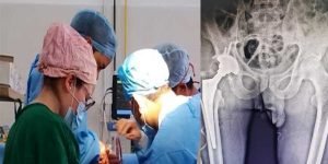 Arunachal: Total Hip Replacement Surgery done at Tawang dist Hospital